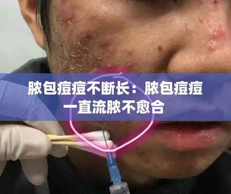 膿包痘痘不斷長：膿包痘痘一直流膿不愈合 