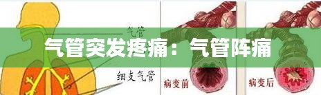 氣管突發(fā)疼痛：氣管陣痛 