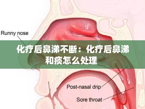 化療后鼻涕不斷：化療后鼻涕和痰怎么處理 