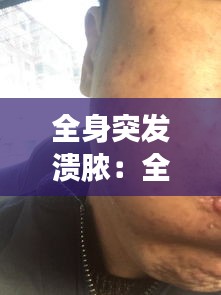 全身突發(fā)潰膿：全身皮膚潰爛化膿怎么辦 