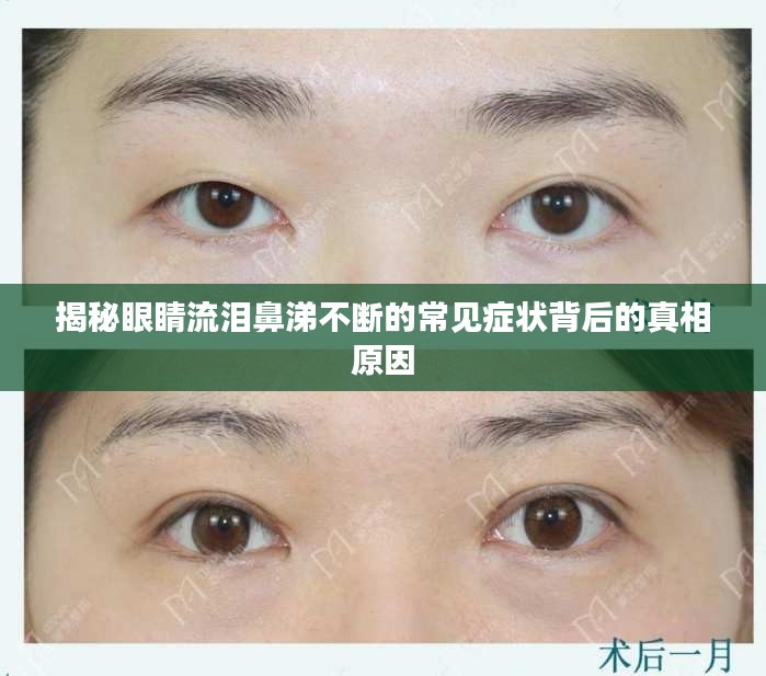 揭秘眼睛流淚鼻涕不斷的常見癥狀背后的真相原因